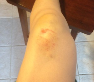 bruised knee